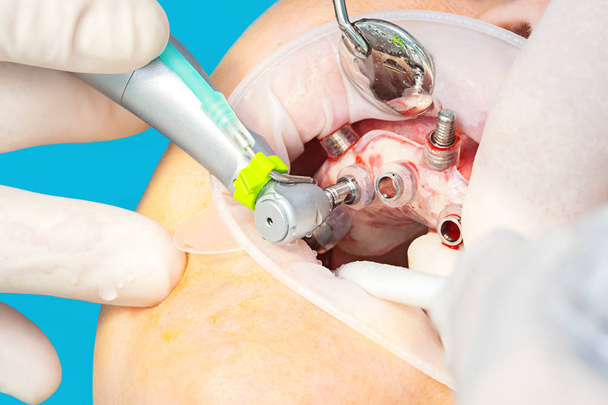 Nahaufnahme der digital geführten Implantatchirurgie am Patienten - neue Implantattechnologie in der Zahnmedizin. - Foto, Bild