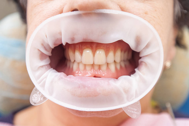 Set of dentures. Close up photo of teeth. Diagnosis and copayment - Фото, изображение