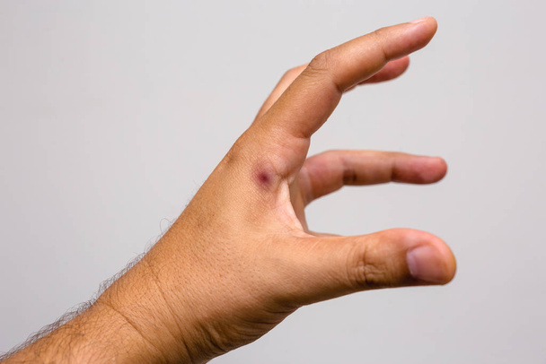 foto de una picadura de escorpión en la mano de una persona. Picadura de escorpión, peligro veneno de escorpión
. - Foto, Imagen