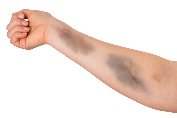 Grote blauwe plekken op de menselijke arm. Huiselijk geweld. - Foto, afbeelding
