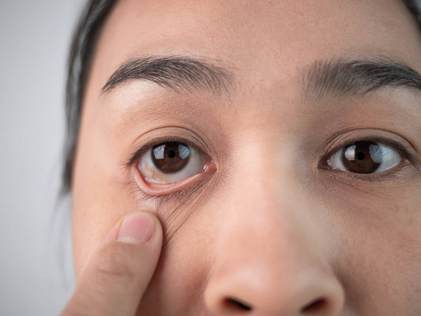 Mujer asiática tiene problemas con el dolor ocular, Sufriendo de la inflexión del ojo o conjuntivitis. Concepto de salud
. - Foto, imagen