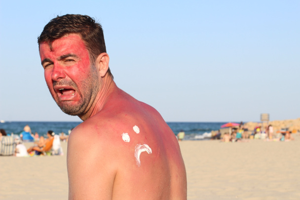 Mann bekommt am Strand Sonnenbrand - Foto, Bild