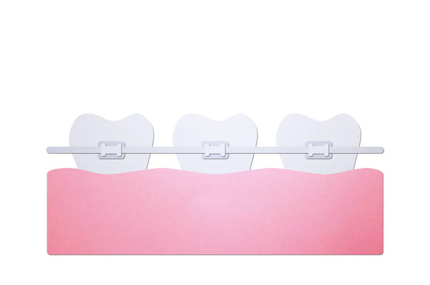 Ortodontyczne zęby lub aparat dentystyczny - Zdjęcie, obraz