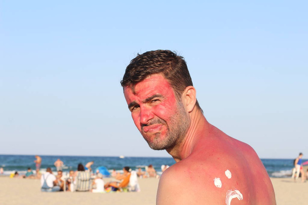 L'uomo che si scotta al sole in spiaggia
 - Foto, immagini