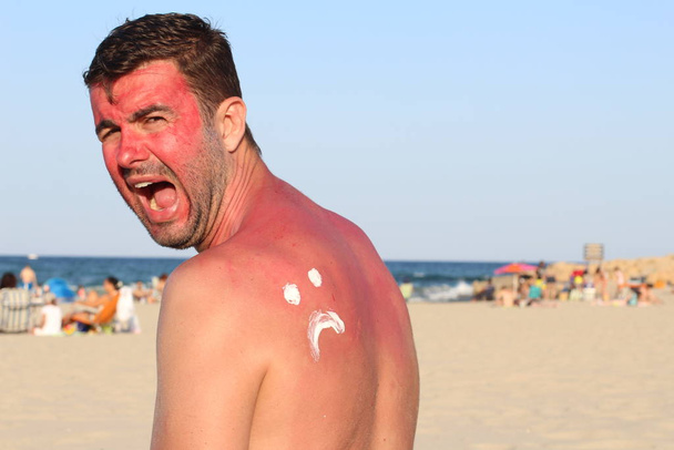 L'uomo che si scotta al sole in spiaggia
 - Foto, immagini