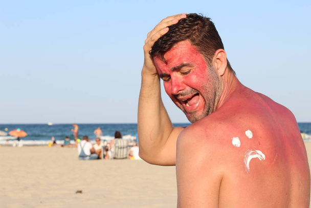 Hombre recibiendo sol quemado en la playa
 - Foto, Imagen