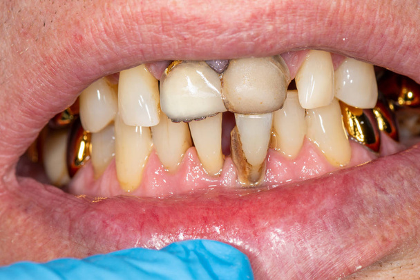 Close-up van macro tandheelkundige calculus en tandplak. Orale hygiëne - Foto, afbeelding