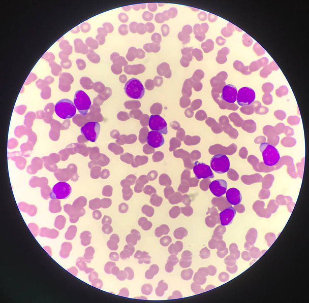 Пациенты с незрелыми клетками или бастовыми клетками при лейкемии
. - Фото, изображение