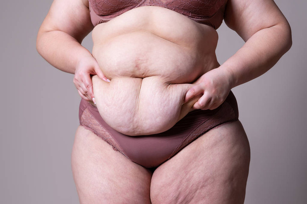 Tummy tuck, flabby skin on a fat belly, plastic surgery concept - Foto, imagen