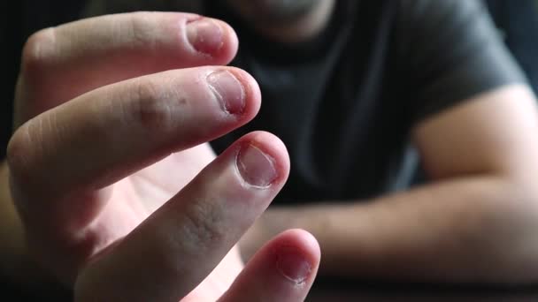 Close view van mannelijke handen met sterk gebeten nagels. Vingerselectie met alarm. Lelijke gebeten vingers, nagelriemen, wonden in de vingers. Slechte gewoonte. Het concept van onychophagy en dermatofaag. - Video