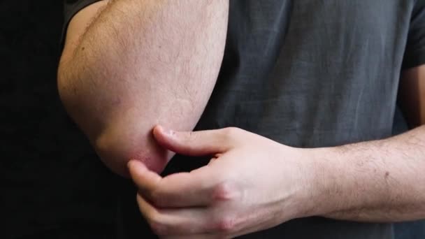 A man scratches a rough patch of skin on his elbow, a seasonal skin problem. Shots of a person scratch the skin, show skin disease. - Footage, Video