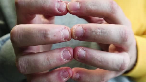 Ugly ugryzienie fingers, biting nails, cuticles, wounds on the fingers. Nail-biting habit. The concept of onychophagy. unattended nail, cracked skin, bad nail grooming. - 映像、動画