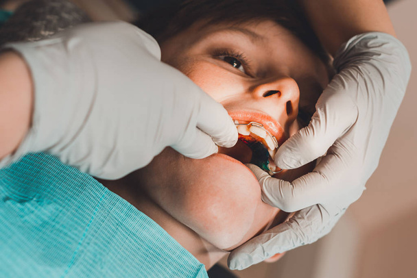 De jongen met zijn mond open ligt in de stoel van de tandarts terwijl de orthodontist de plaat op zijn tanden houdt. - Foto, afbeelding