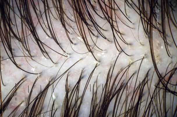 Kopfhaut und Haare mit mehrfachem Peeling. Makroskopie der Haare auf dem Kopf mit Anzeichen von Peeling an Haarfollikeln. Kopfhautdermoskopie. Haarbehandlung in der Klinik. - Foto, Bild