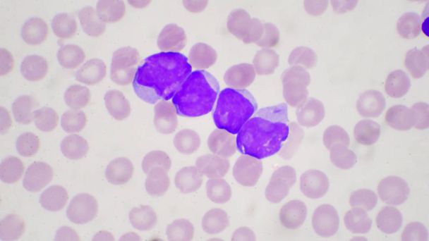 Células de explosão na leucemia pateínas no esfregaço de sangue
. - Foto, Imagem