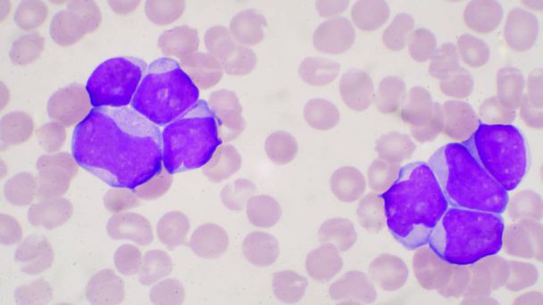 Blaascel bij leukemie pateins in bloeduitstrijkje. - Foto, afbeelding