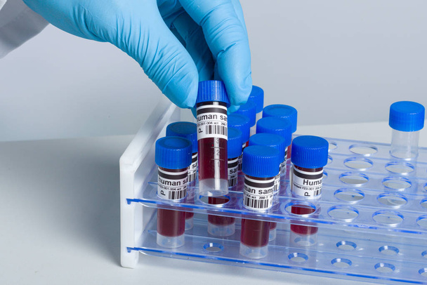 mano in guanti medici ottenere campione di sangue umano da un rack tubo
 - Foto, immagini