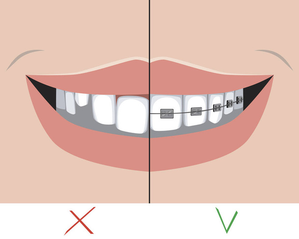 歯や歯の矯正クリニックの治療コンセプトとしての笑顔で金属のブレースと曲がった歯、治療前と治療後の臼歯や切開部の問題のベクトルストックイラスト - ベクター画像