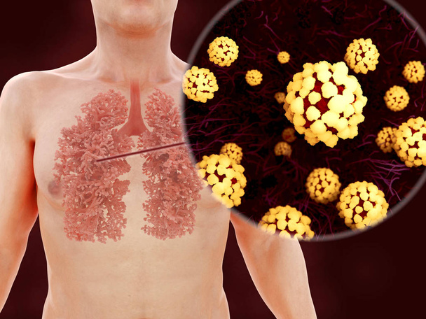 Sars disease, coronaviruses in the lung - Photo, Image
