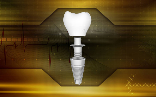 Digital illustration Dental implant in colour background 	 - Photo, image