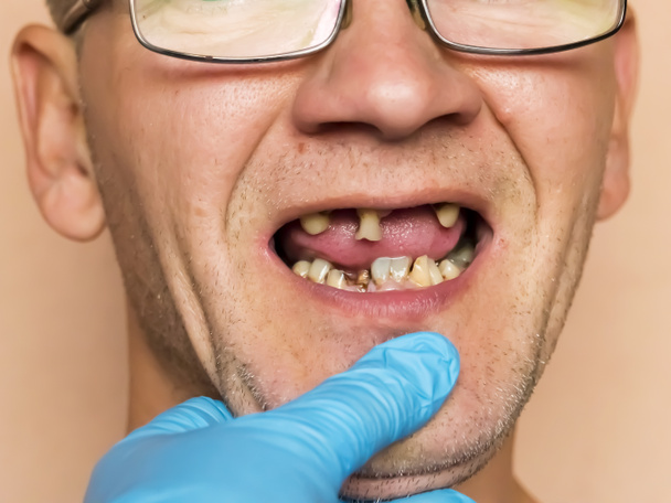 Hastalıklı dişler. Yoğun çürüme, bakteriler, diş dökülmesi. Tedavi, restorasyon ve protezlerden önce dişçi tarafından muayene edilen bir adam.. - Fotoğraf, Görsel