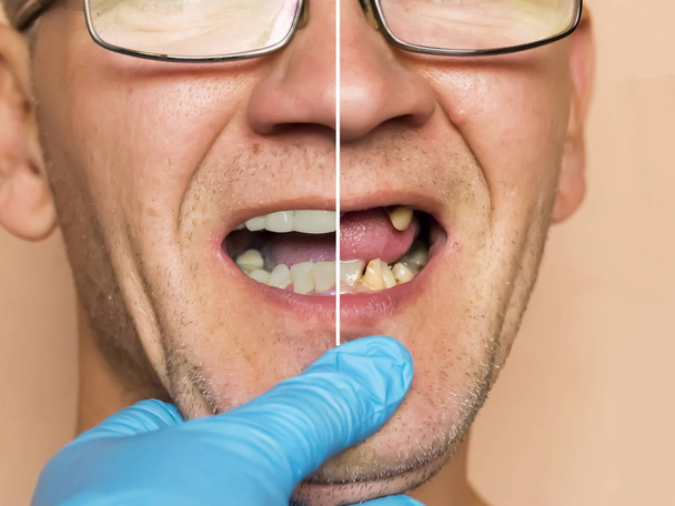 Hastalıklı dişler. Yoğun çürüme, bakteriler, diş dökülmesi. Muayene edilen bir adam. - Fotoğraf, Görsel
