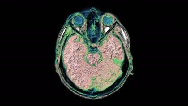 Luzem wielobarwne Mri skany mózgu i głowy w celu wykrycia guzów. Diagnostyczne narzędzie medyczne - Materiał filmowy, wideo