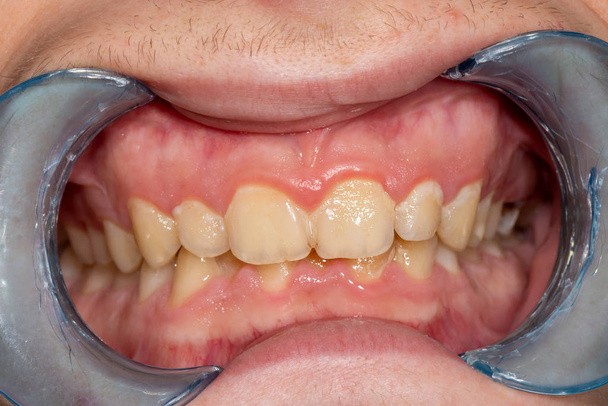 Cáries e doenças dentárias. Enchimento com um fótopo composto dental
 - Foto, Imagem