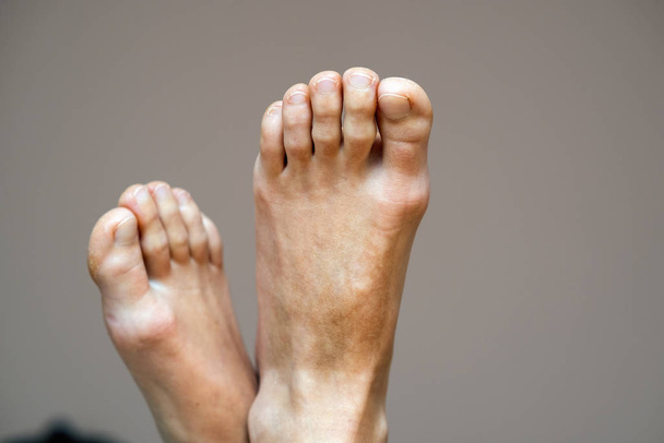 Крупним планом жіночі ноги тільки з сухою тріщиною шкіри. Ноги і пальці ніг
  - Фото, зображення