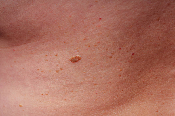 Age spots, moles and freckles on the body close-up. Spots on the body. The texture of the skin with moles and freckles - Photo, Image