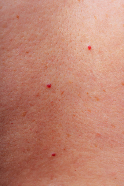 Age spots, moles and freckles on the body close-up. Spots on the body. The texture of the skin with moles and freckles - Photo, Image