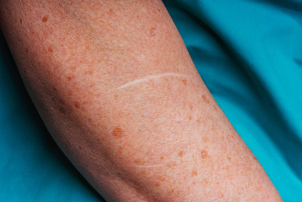 Oude littekens op het lichaam van een oudere vrouw. Littekens van een auto-ongeluk. Sporen van diepe sneden en krassen - Foto, afbeelding