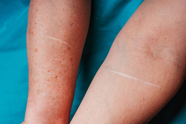 Oude littekens op het lichaam van een oudere vrouw. Littekens van een auto-ongeluk. Sporen van diepe sneden en krassen - Foto, afbeelding