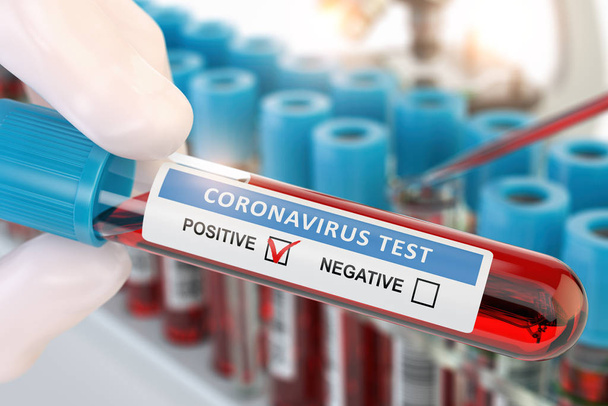 Coronavirus 2019 nCoV positive blood test. Blood sample in lhand - Foto, afbeelding
