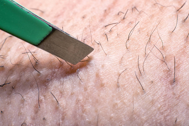 Close up using tweezers to remove hair from armpit. - Fotoğraf, Görsel