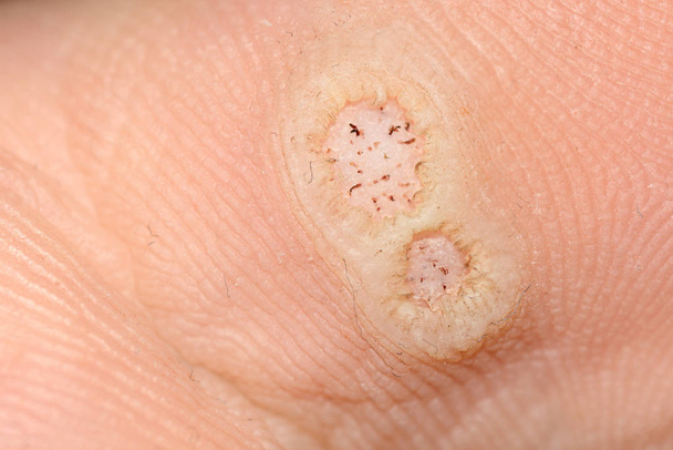 Verrues plantaires causées par le papillomavirus humain, ou VPH, sur un pied infecté
 - Photo, image