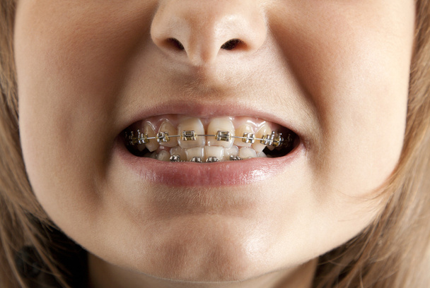 Girl smiles with bracket on teeth - Photo, Image