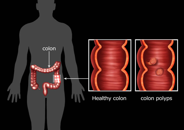 ヒトの大腸ポリープのイラスト - 写真・画像