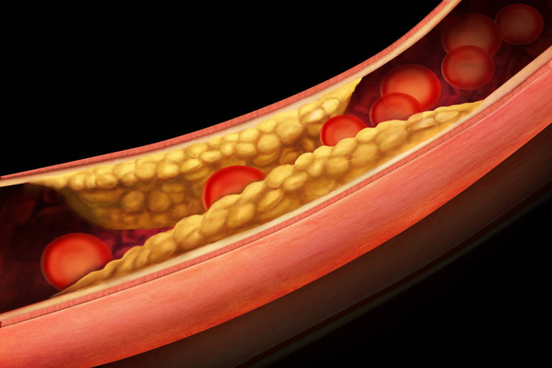 Атеросклероз артерий - Фото, изображение