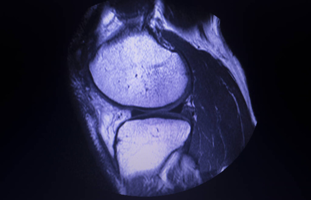 Mri の膝のメニスカスの裂け目スキャン - 写真・画像