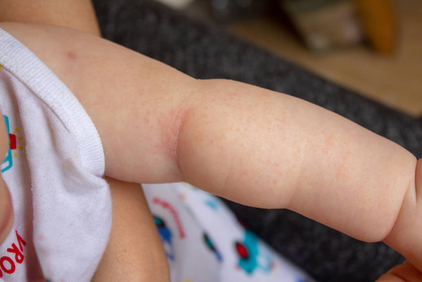 Stekelige hitte. Close-up van de plooien van de hand van een pasgeboren baby met rode huid. - Foto, afbeelding