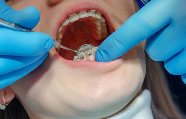Δόντια σε οδοντιατρική κλινική, σιδεράκια εγκαθίστανται - Φωτογραφία, εικόνα