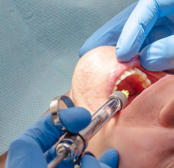 Il medico fa l'iniezione di anestetico al paziente in clinica dentale
 - Foto, immagini