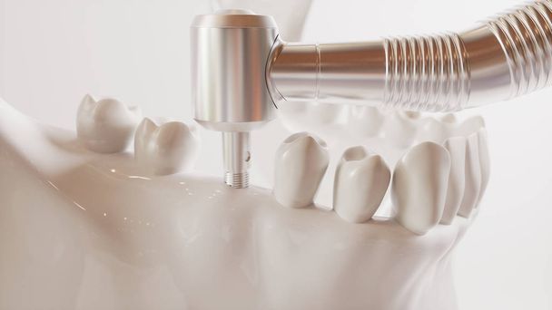 Imagen de implante dental serie V02 - 3 de 8 - Renderizado 3D
 - Foto, Imagen