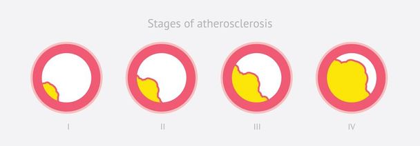 Etapas de aterosclerosis en la arteria
 - Vector, imagen