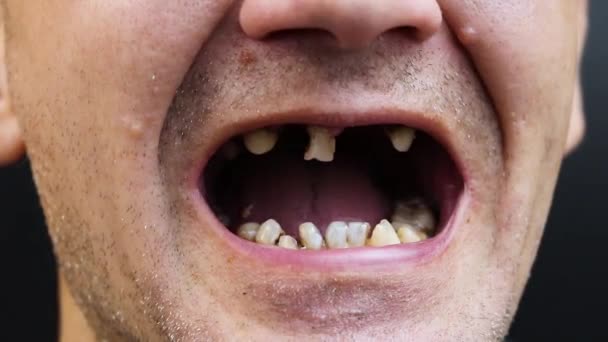 L'homme a des dents pourries, des dents tombées, des dents jaunes et noires blessées. Mauvais état des dents, érosion, caries. Le médecin prépare le patient pour le traitement - Séquence, vidéo