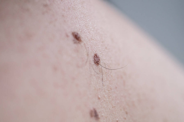 Checking benign moles. Close up detail of the bare skin on a man back with scattered moles and freckles. - Photo, Image