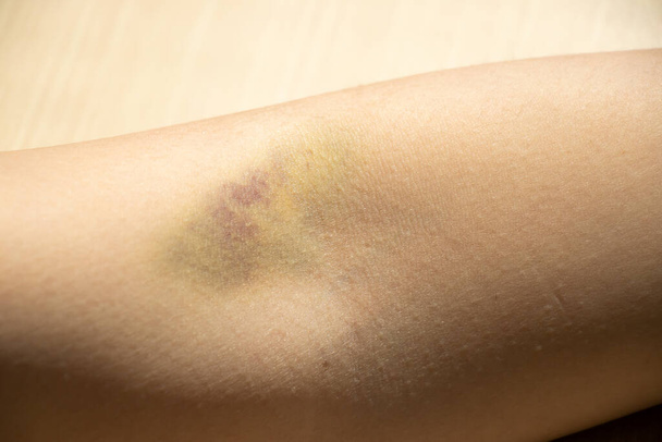 Bruise injury on the female arm background - Photo, Image