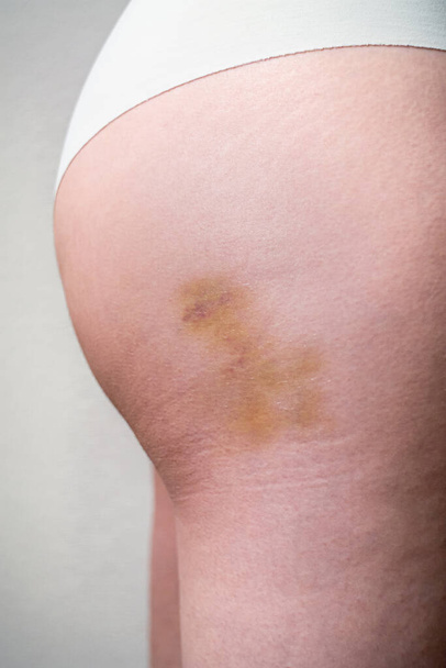 Skin bruises on Caucasian female buttocks side view close up sho - Photo, Image