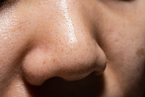 Gros plan femmes du visage montrent les petits boutons points noirs sur la peau du nez
. - Photo, image